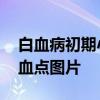 白血病初期小血点图片 白血病的早期症状出血点图片