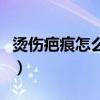 烫伤疤痕怎么能彻底消除（被油烫伤怎么处理）